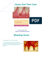 Bleeding Gums and Their Care
