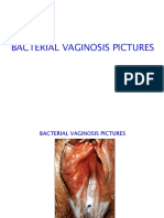 Bacterial Vaginosis Pictures