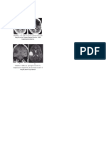 CT - Scan Dan MRI Astrositoma