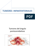 TUMORES Infratentoriales