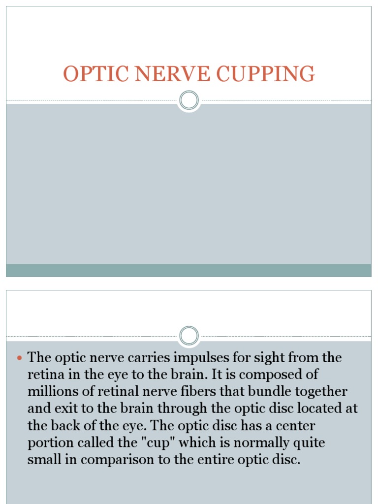 Optic Nerve Cupping | PDF