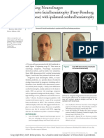Teaching Neuroimages: Progressive Facial Hemiatrophy (Parry-Romberg Syndrome) With Ipsilateral Cerebral Hemiatrophy
