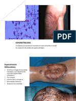 Esporotricosis