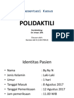 Polidaktili