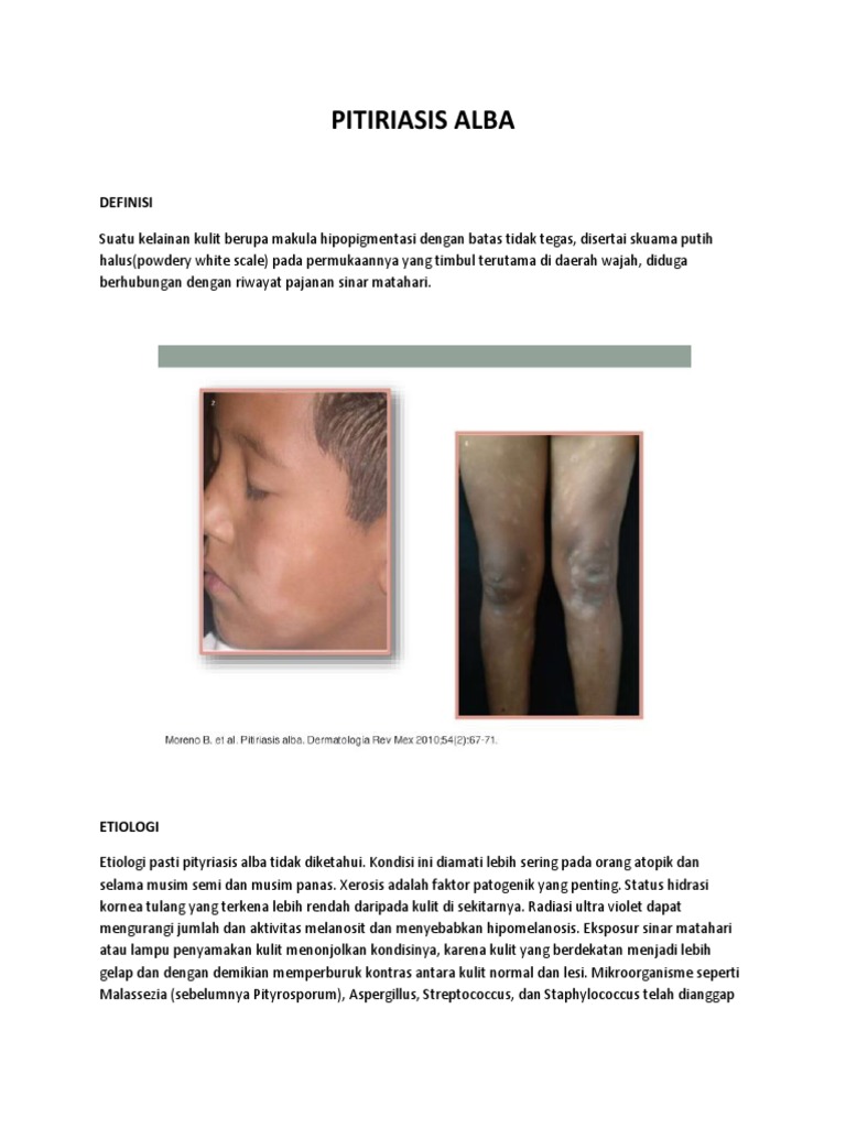 Pitiriasis Alba Word | PDF
