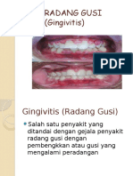 Radang Gusi