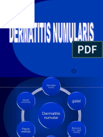 Dermatitis Numularis,Tia