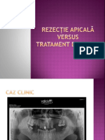 Rezectie Apicala Versus Tratament de Canal