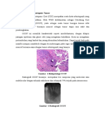 Calcifying Cystic Odontegenic Tumor