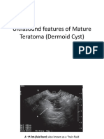 Ultrasound Features of Mature Teratoma (Dermoid Cyst)