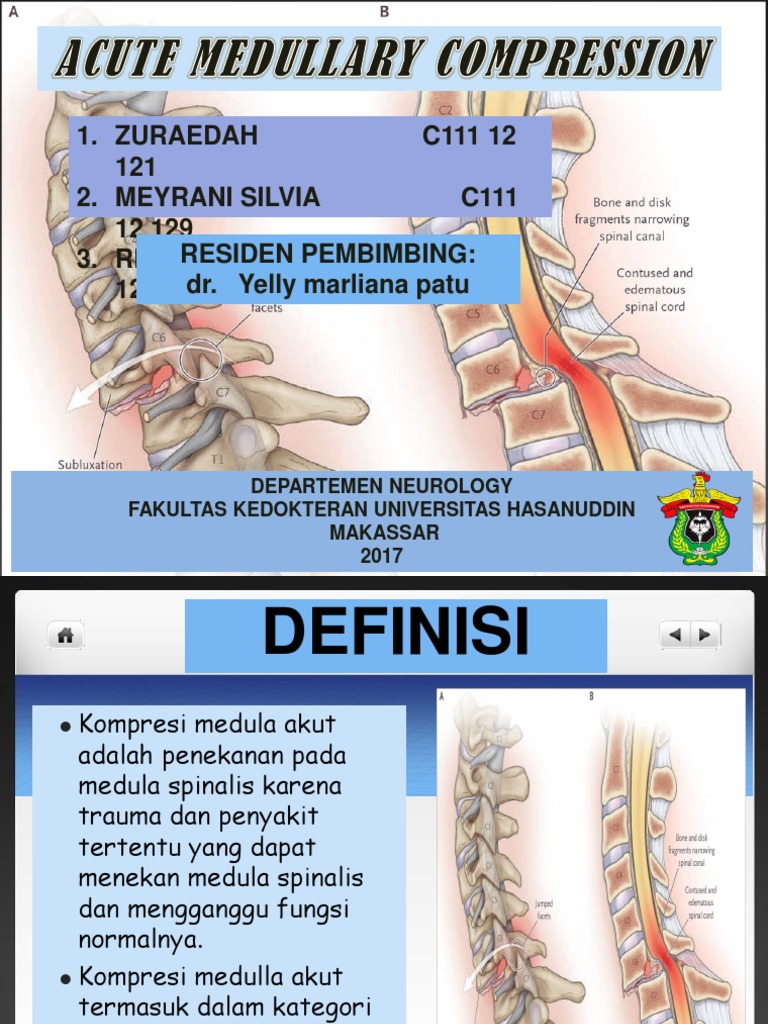 Kompresi Medula Spinalis Akut | PDF