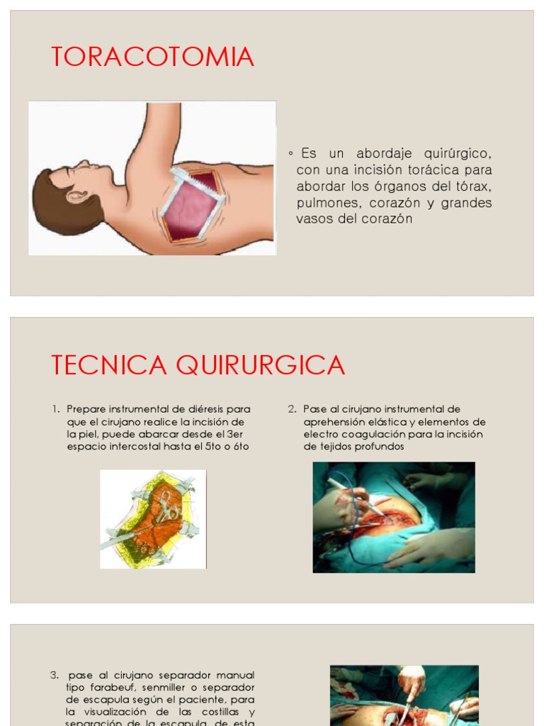 Toracotomia | PDF