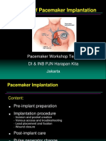 Pacemaker Implant