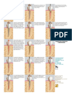 Endo - System B Continous Wave Compaction Technique