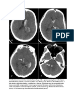 CT at The Time of Onset of Intraventricular Hemorrhage
