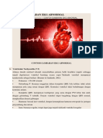 Contoh Gambaran Ekg Abnormal