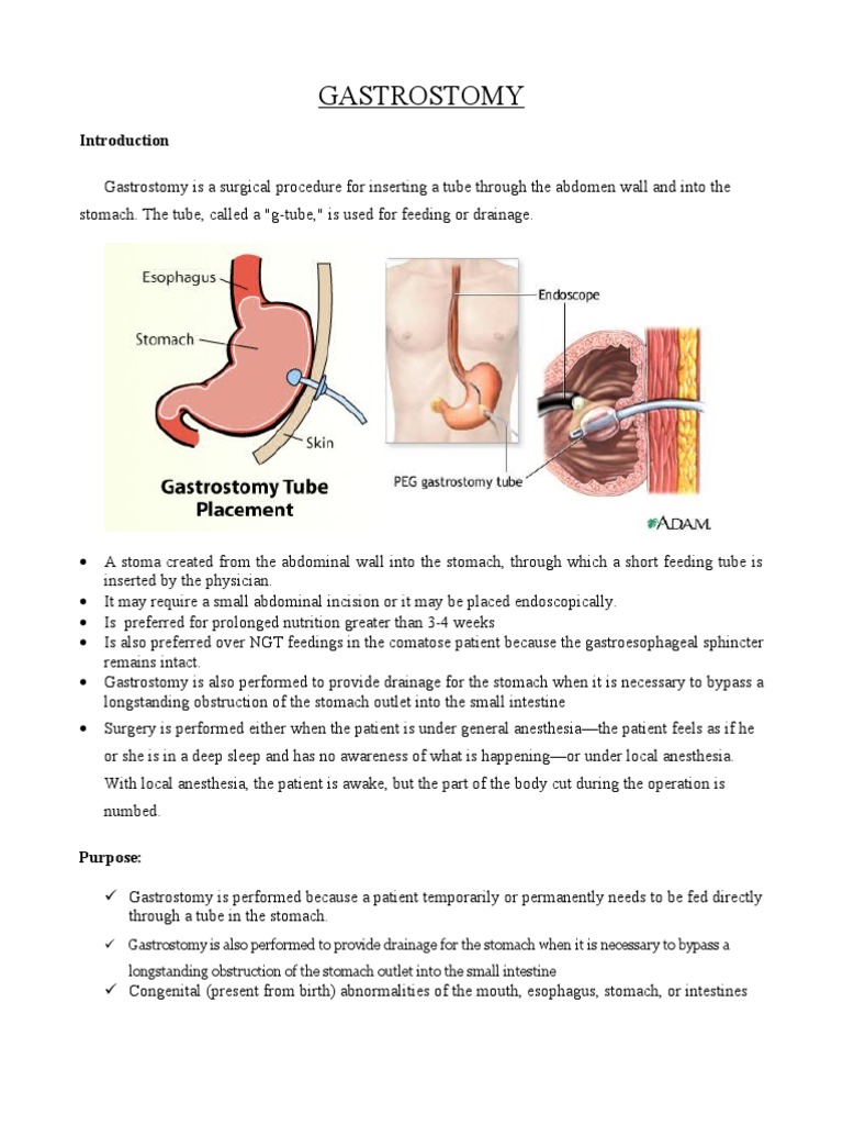 GASTROSTOMY PDF Health Sciences Gastroenterology