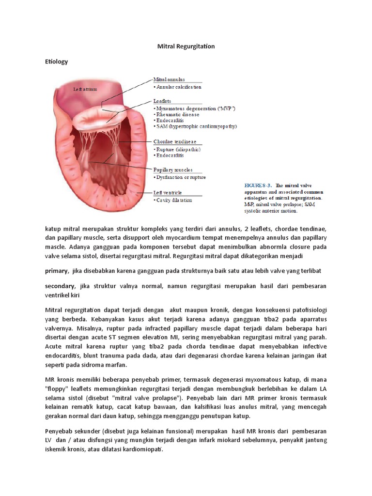 Mitral Regurgitation | PDF