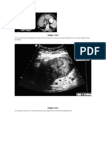 Carcinoma Hepatocelular (1)