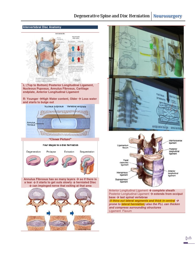 Degenerative Spine Diseases | Download Free PDF | Vertebral Column ...