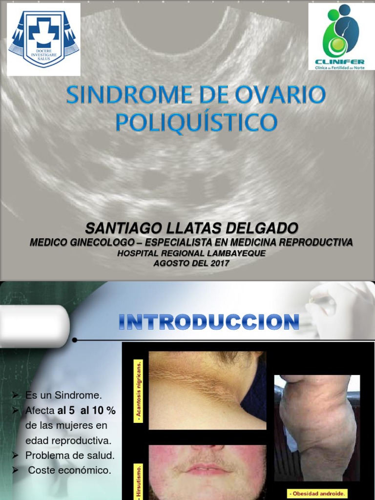 Sindrome de Ovario Poliquistico | PDF | Sistema reproductivo ...
