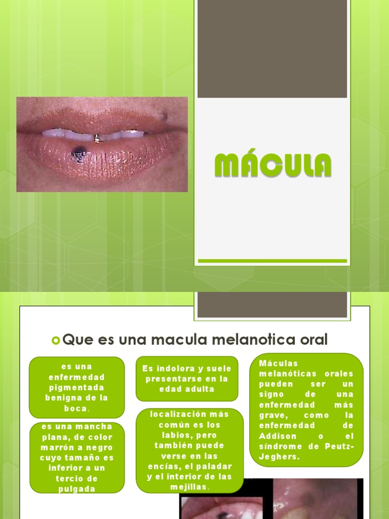 mácula melanótica oral causas Mácula Melanótica Oral: Causas y Tratamiento | PDF | Inflamación