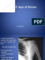 X-rays Reveal Teen's Bone Infection