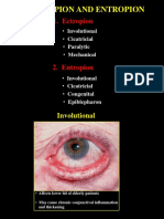 06ectropion & Entropion