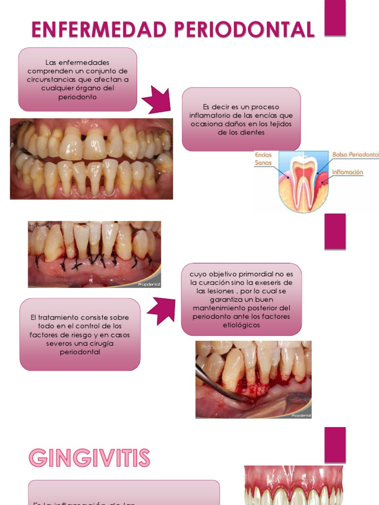 Enfermedad Periodontal | PDF | Enfermedades y trastornos ...