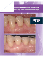 Injerto de Tejido Conectivo Subepitelial Control de La Estabilidad a Largo Plazo. Técnica de Langer-Langer