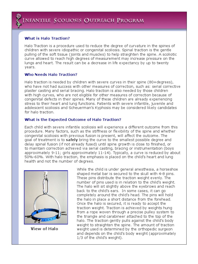 Understanding Halo Traction for Scoliosis | PDF | Scoliosis | Medical ...