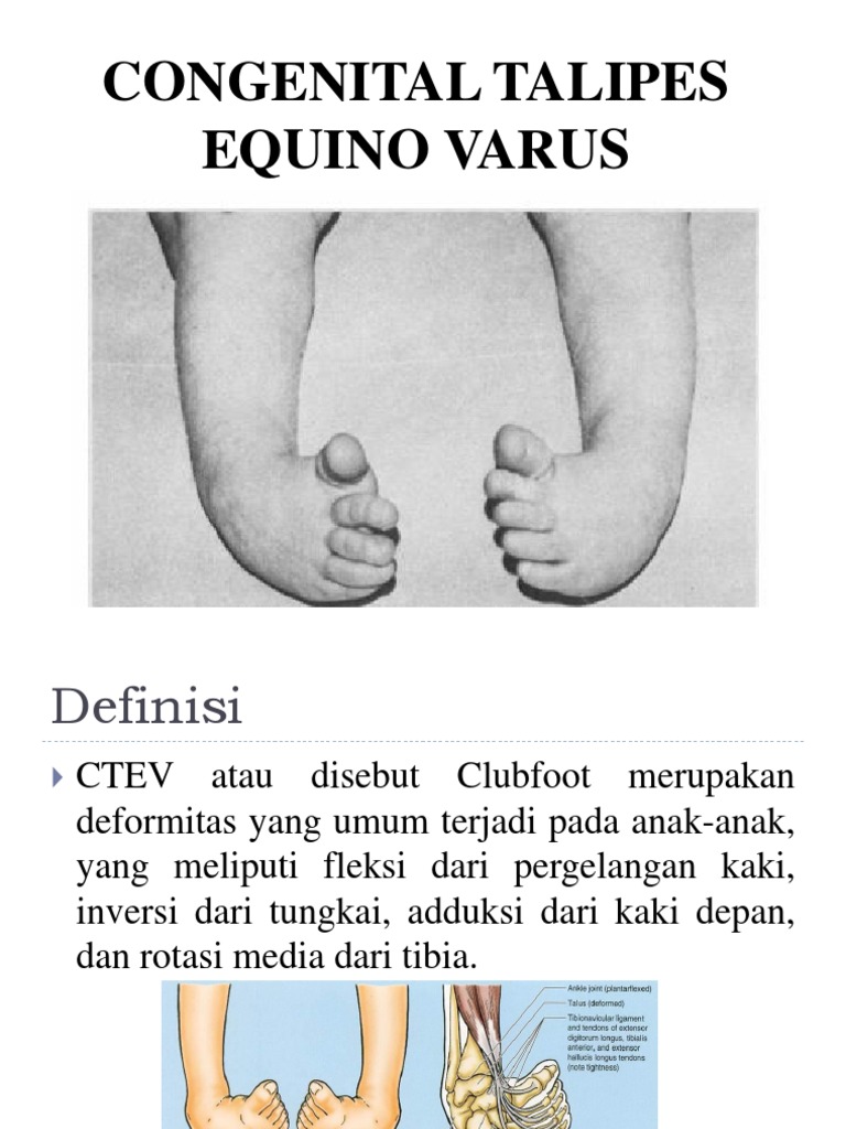 Congenital Talipes Equino Varus | PDF | Pengembangan Diri | Sains ...