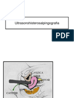 Ultrasonohisterosalpingografia.ppt
