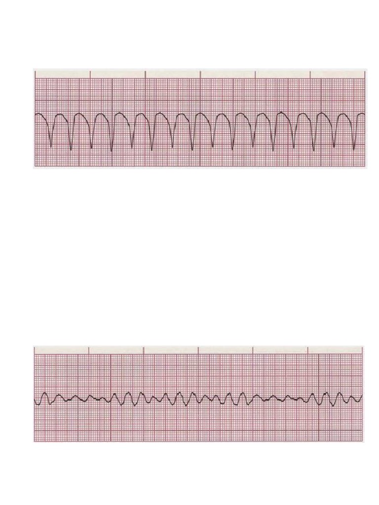 Gambaran EKG | PDF