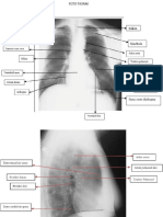 Radiologi Tb Paru