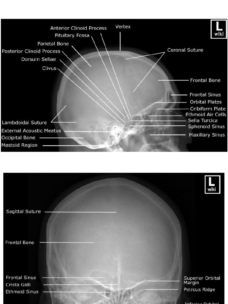 Analisis Rontgen dan CT Sinusitis