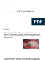 Afectación periapical