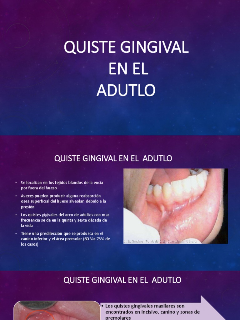 Quiste Gingival Enfermedades y trastornos Anatomía humana