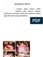 Gamb. Klinis Crenated Tongue - Diskusi