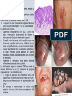 Cuadro Clinico Carcinoma Epidermoide