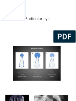 Radicular Cyst