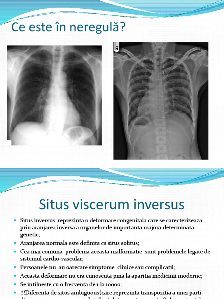 Situs Viscerus Inversus | PDF