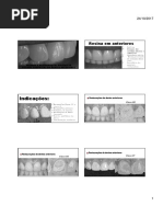 Restauracoes Em Dentes Anteriores (1)