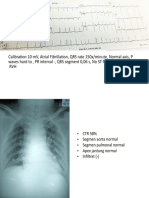 AFib, Rapid Ventricular Rate, Normal EKG