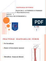 Fractura Diafisaria de Femur