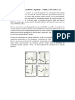 Aumento de La Aurícula Izquierda y Fibrilación Auricular