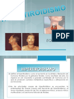 hipertiroidismo-130429234907-phpapp01