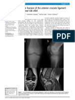 Avulsion Fracture of The Anterior Cruciate Ligament in A 9-Year-Old Child