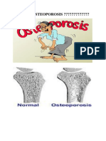 Gambar Osteoporosis