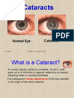 EYE SAFETY Cataract Information JVC